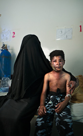 Saada, Yemen- 2017, Oct:  <p class='fr'>Nachmi (9) est arrivé à l'hôpital public de Saada la veille, le 28 octobre 2017 après avoir été la cible d’un bombardement aérien avec son frère Chaher (11) lui aussi gravement blessé à la tête. Ils gardaient leurs bêtes lorsqu'une première bombe les a frappés, puis une deuxième est tombée sur des amis venus leur porter secours.
</p> <p class='en'>Nachmi (9) and his brother Chaher (11) were hit by an airstrike on the 28th of october 2017 as they were looking after their animals. They are both treated at the public hospital in Saada. </p>
